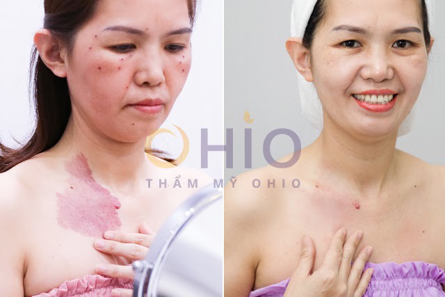 5 yếu tố để xóa chàm bớt bẩm sinh thành công - Phòng khám da liễu OHIO 5 yếu tố để xóa chàm bớt bẩm sinh thành công