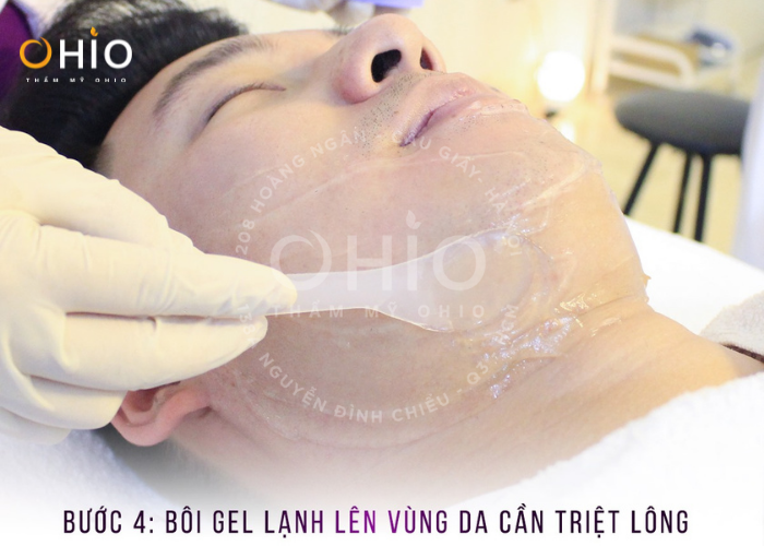 Rắc rối mùi dưới cánh tay - Xua ngay với triệt lông Aqua Max - Phòng khám da liễu OHIO Bôi gel mát lạnh lên vùng chuẩn bị triệt