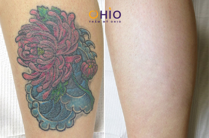 Tại sao nên chọn xóa xăm ở OHIO thay vì các cơ sở khác? - Phòng khám da liễu OHIO ket-qua-xoa-xam-tai-ohio