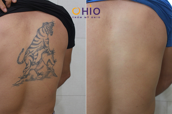 Tại sao nên chọn xóa xăm ở OHIO thay vì các cơ sở khác? - Phòng khám da liễu OHIO ket-qua-xoa-xam-tai-ohio