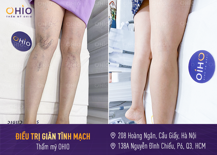 HÀNH TRÌNH 11 NĂM OHIO - CHẶNG ĐƯỜNG CHINH PHỤC HƠN 1 TRIỆU KHÁCH HÀNG - Phòng khám da liễu OHIO tri-gian-tinh-mach-tai-ohio