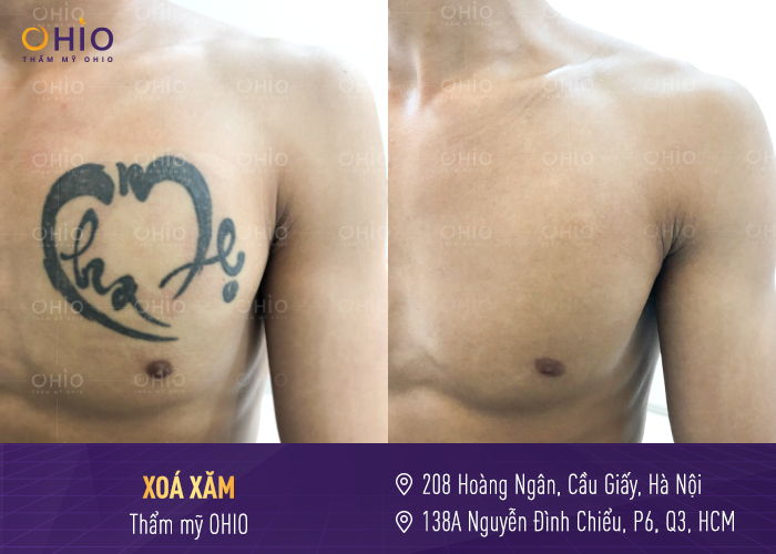 HÀNH TRÌNH 11 NĂM OHIO - CHẶNG ĐƯỜNG CHINH PHỤC HƠN 1 TRIỆU KHÁCH HÀNG - Phòng khám da liễu OHIO xoa-xam-tai-ohio