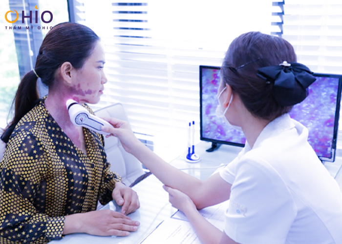 OHIO chi mạnh đầu tư hệ thống máy laser điều trị xóa chàm bớt sắc tố, u máu - Phòng khám da liễu OHIO kham-xoa-cham-bot