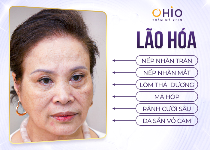 Chuyên gia nói gì về xu hướng làm đẹp mới GOLDMAX 2022 - Phòng khám da liễu OHIO lao-hoa