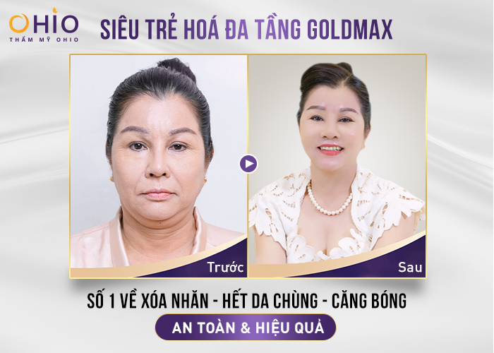 GOLDMAX - Công nghệ nâng cơ xóa nhăn dẫn đầu thị trường 2022 - Phòng khám da liễu OHIO Kết quả điều trị công nghệ nâng cơ xóa nhăn goldmax khách hàng 55 tuổi