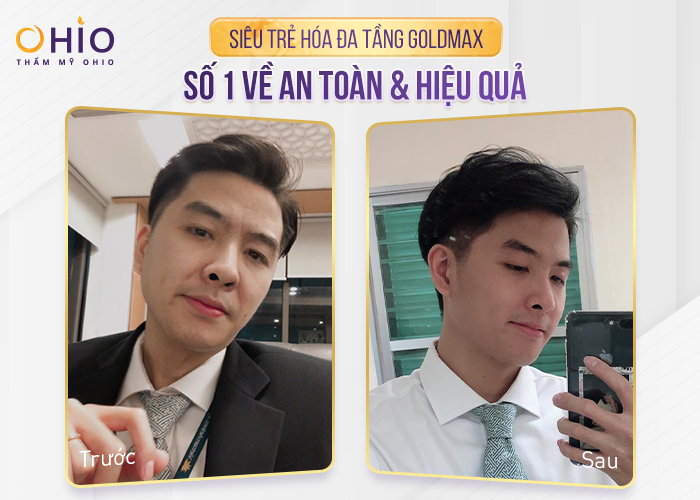 GOLDMAX - Công nghệ nâng cơ xóa nhăn dẫn đầu thị trường 2022 - Phòng khám da liễu OHIO Kết quả điều trị công nghệ nâng cơ xóa nhăn goldmax khách hàng nam