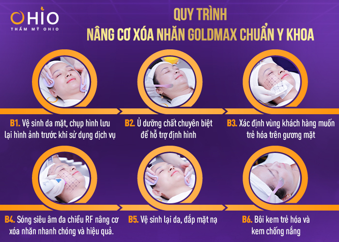 GOLDMAX - Công nghệ nâng cơ xóa nhăn dẫn đầu thị trường 2022 - Phòng khám da liễu OHIO Quy trình nâng cơ xóa nhăn goldmax