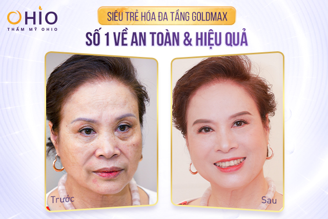 NSND Thanh Thủy, diễn viên Mạnh Quân, Hoàng Yến, Hari Oanh,...Bật mí về làn da trẻ đẹp của mình nhờ công nghệ Goldmax - Phòng khám da liễu OHIO NSND Thanh Thủy đảo ngược 10 năm vòng quay lão hóa