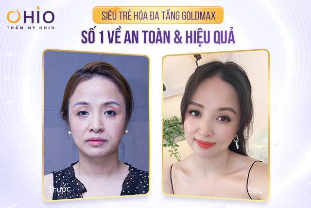 NSND Thanh Thủy, diễn viên Mạnh Quân, Hoàng Yến, Hari Oanh,...Bật mí về làn da trẻ đẹp của mình nhờ công nghệ Goldmax - Phòng khám da liễu OHIO Diễn viên Hoàng Yến sở hữu làn da căng bóng sau khi trải nghiệm công nghệ goldmax 4.0