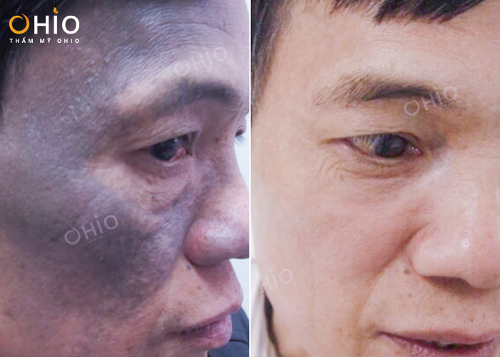OHIO chi mạnh đầu tư hệ thống máy laser điều trị xóa chàm bớt sắc tố, u máu - Phòng khám da liễu OHIO ket-qua-xoa-cham-bot-tai-ohio-3