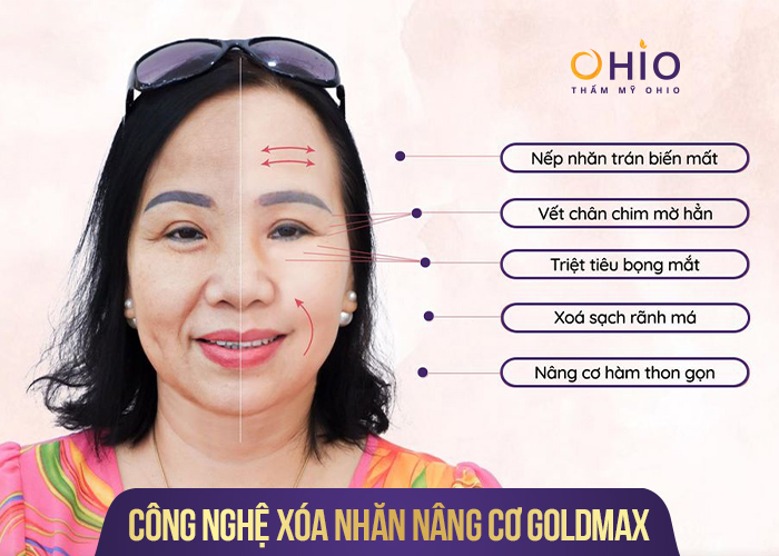 Chuyên gia nói gì về xu hướng làm đẹp mới GOLDMAX 2022 - Phòng khám da liễu OHIO tre-hoa-da-mat-voi-goldmax-2022