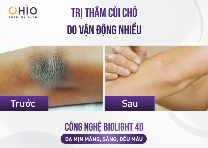 Bí quyết trị thâm mông, nách, bẹn, chân, tay hiệu quả - Phòng khám da liễu OHIO Bí quyết trị thâm mông, nách, bẹn, chân, tay hiệu quả