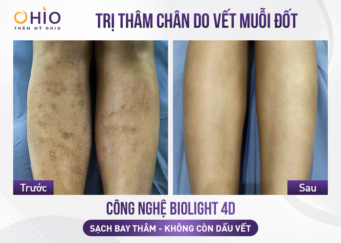 Bí quyết trị thâm mông, nách, bẹn, chân, tay hiệu quả - Phòng khám da liễu OHIO Bí quyết trị thâm mông, nách, bẹn, chân, tay hiệu quả