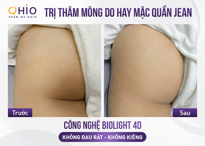 Bí quyết trị thâm mông, nách, bẹn, chân, tay hiệu quả - Phòng khám da liễu OHIO Bí quyết trị thâm mông, nách, bẹn, chân, tay hiệu quả