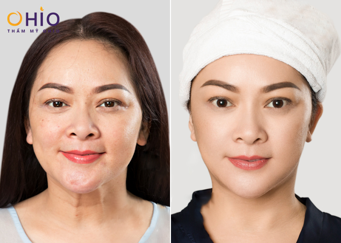 Quy trình cấy chỉ nguyên bào sợi được thực hiện như thế nào tại đơn vị uy tín? - Phòng khám da liễu OHIO Trẻ hóa da cấy chỉ nguyên bào sợi next levl