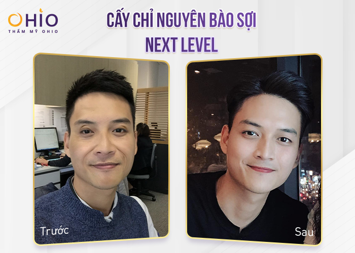 Quy trình cấy chỉ nguyên bào sợi được thực hiện như thế nào tại đơn vị uy tín? - Phòng khám da liễu OHIO Hiệu quả Cấy nguyên bào sợi Next Level