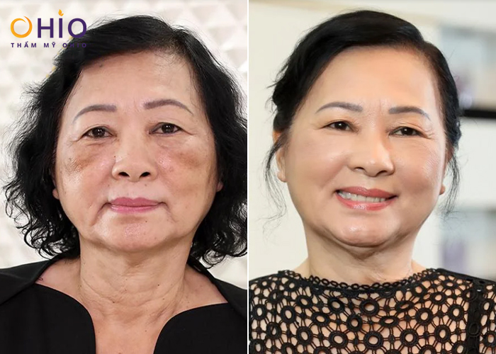 Quy trình cấy chỉ nguyên bào sợi được thực hiện như thế nào tại đơn vị uy tín? - Phòng khám da liễu OHIO Cấy nguyên bào sợi Next Level trẻ hóa da như thế nào?