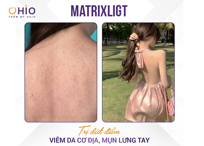 Tổng quan về viêm nang lông: Tình trạng, nguyên nhân và công nghệ điều trị hiệu quả - Phòng khám da liễu OHIO cach-tri-dut-diem-viem-nang-long-1