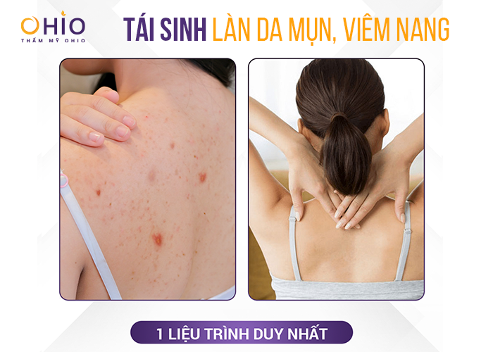 Tổng quan về viêm nang lông: Tình trạng, nguyên nhân và công nghệ điều trị hiệu quả - Phòng khám da liễu OHIO cach-tri-dut-diem-viem-nang-long-3