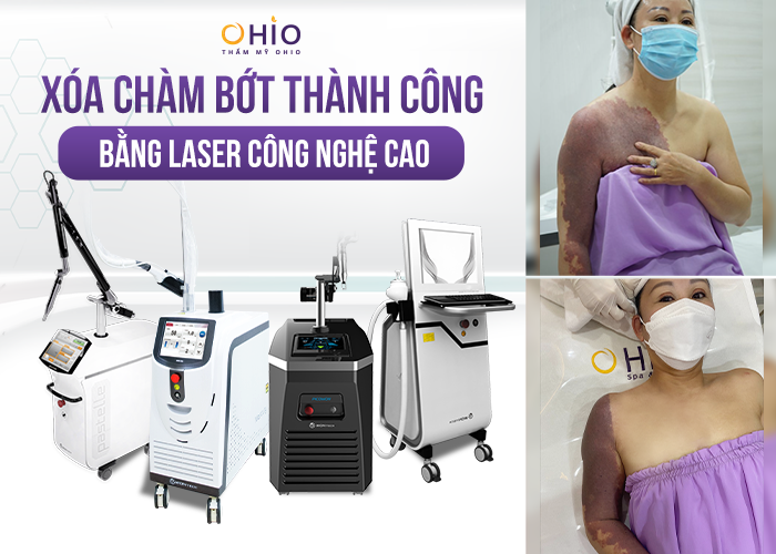 Tổ hợp công nghệ xóa chàm bớt tại chiến dịch “Thoát bớt” mùa 1 - Phòng khám da liễu OHIO Xóa chàm bớt hiệu quả