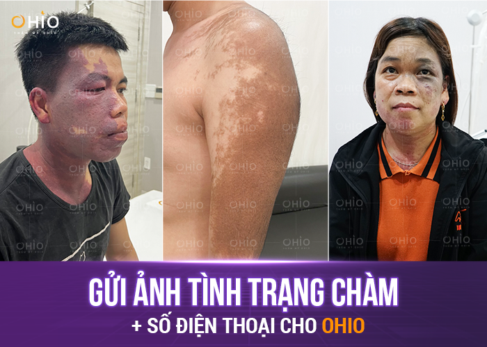 Làm sao để tham gia chiến dịch "Thoát Bớt" - Nhận tài trợ xóa chàm tới 2 Tỷ?