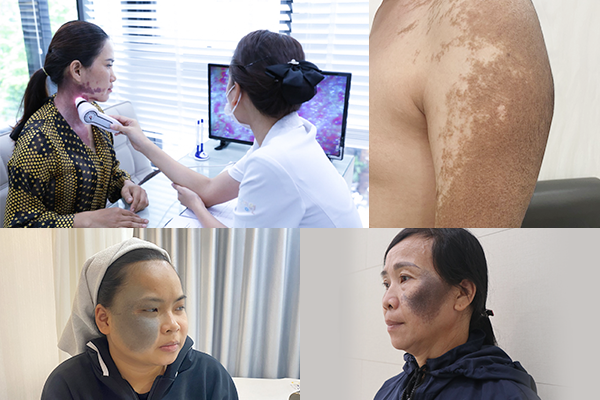 Ai sẽ là người chữa chàm bớt cho bạn tại "Chiến dịch Thoát Bớt" mùa 1 - Phòng khám da liễu OHIO chàm bớt bẩm sinh