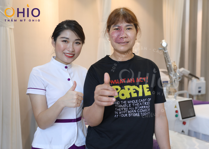 Theo chân hành trình lột xác của người phụ nữ chàm bớt u máu nửa mặt - Phòng khám da liễu OHIO Theo chân hành trình lột xác của người phụ nữ chàm bớt u máu nửa mặt
