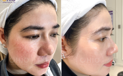 Phòng khám OHIO Sài Gòn khẳng định vị thế điều trị da công nghệ cao khu vực phía Nam - Phòng khám da liễu OHIO Phòng khám OHIO Sài Gòn khẳng định vị thế điều trị da công nghệ cao khu vực phía Nam