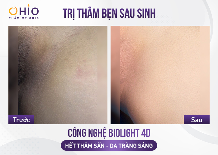 Trị thâm mông, vùng kín cấp tốc bằng cách nào hiệu quả? - Phòng khám da liễu OHIO Trị thâm mông, vùng kín cấp tốc bằng cách nào hiệu quả?