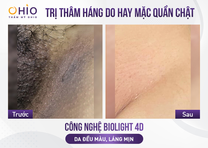 Trị thâm mông, vùng kín cấp tốc bằng cách nào hiệu quả? - Phòng khám da liễu OHIO Trị thâm mông, vùng kín cấp tốc bằng cách nào hiệu quả?