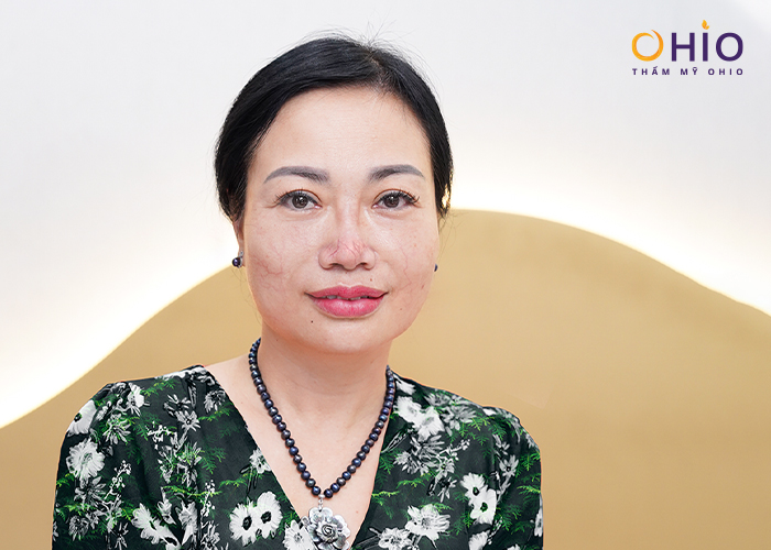 Cô giáo Hồng Vân (Thường Tín) sạch giãn mao mạch thoát "mũi đỏ cà chua” - Phòng khám da liễu OHIO Cô giáo Hồng Vân (Thường Tín) sạch giãn mao mạch thoát "mũi đỏ cà chua”