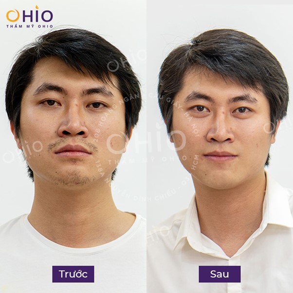 Triệt lông nam Aqua Max - Tiên phong làm đẹp chuẩn Hoa Kỳ - Phòng khám da liễu OHIO Triệt lông nam Aqua Max - Tiên phong làm đẹp chuẩn Hoa Kỳ