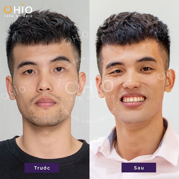 Triệt lông nam Aqua Max - Tiên phong làm đẹp chuẩn Hoa Kỳ - Phòng khám da liễu OHIO Triệt lông nam Aqua Max - Tiên phong làm đẹp chuẩn Hoa Kỳ