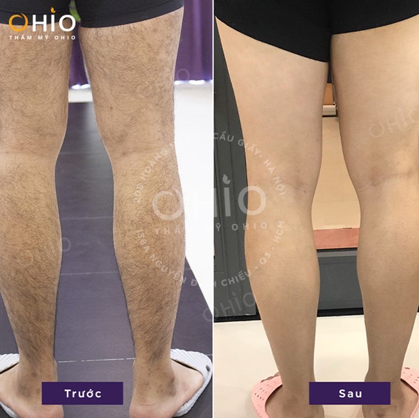 Triệt lông nam Aqua Max - Tiên phong làm đẹp chuẩn Hoa Kỳ - Phòng khám da liễu OHIO Triệt lông nam Aqua Max - Tiên phong làm đẹp chuẩn Hoa Kỳ