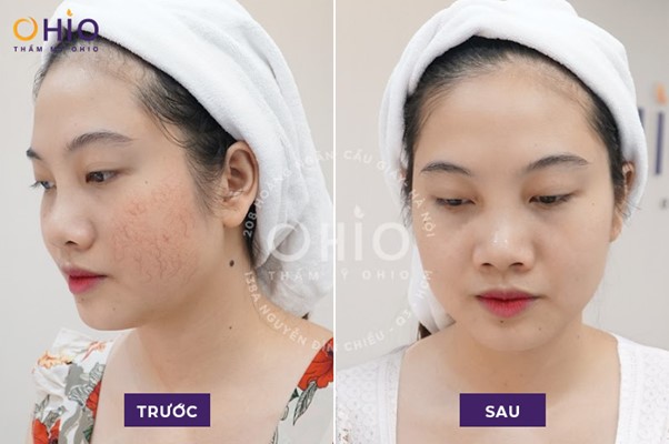 Giãn mao mạch là gì? Nguyên nhân và phương pháp điều trị hiệu quả