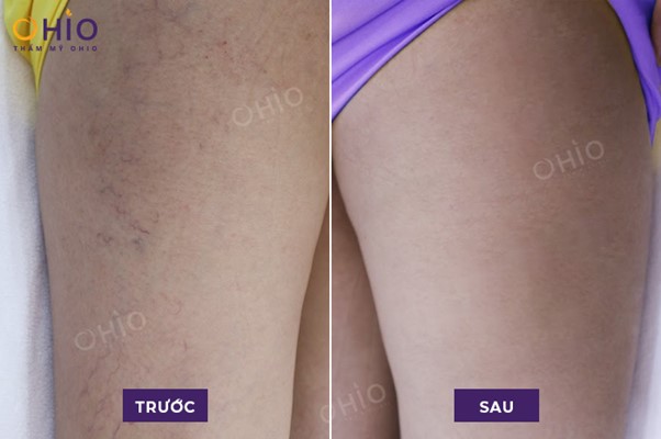 Giãn mao mạch là gì? Nguyên nhân và phương pháp điều trị hiệu quả