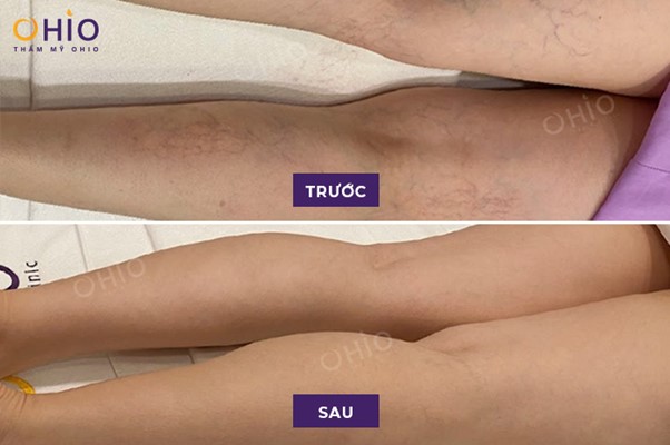 Giãn mao mạch là gì? Nguyên nhân và phương pháp điều trị hiệu quả