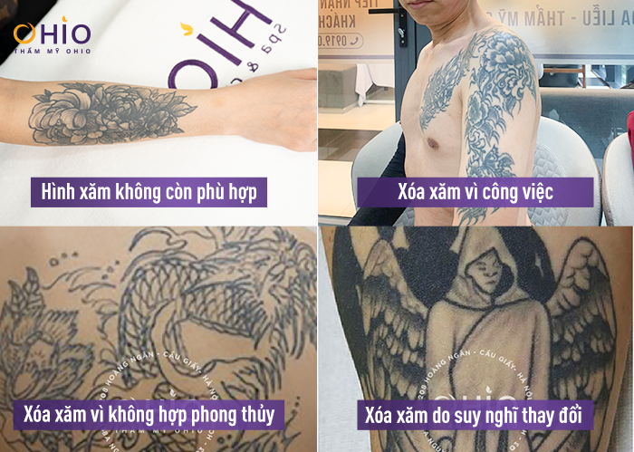 công nghệ xóa xăm Piconew 450