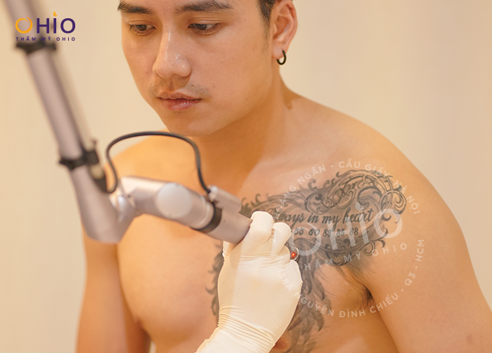 Xóa xăm có để lại sẹo không? Những sai lầm cần tránh