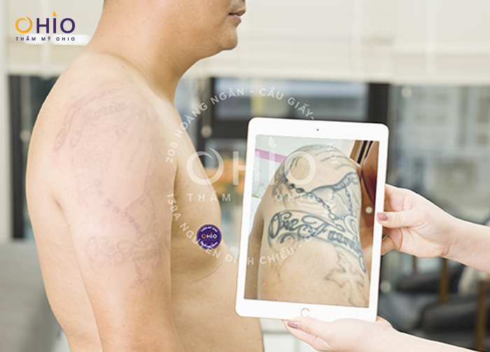 Xóa xăm có để lại sẹo không? Những sai lầm cần tránh