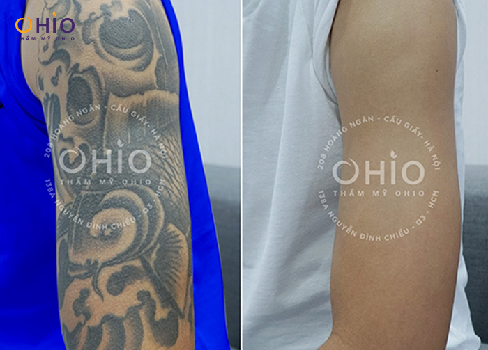 Xóa xăm có để lại sẹo không? Những sai lầm cần tránh