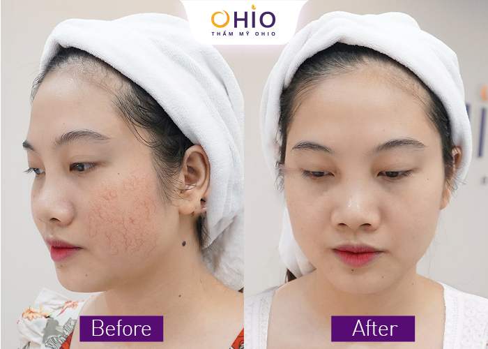Giãn mao mạch vùng mặt là gì? Nguyên nhân và cách trị giãn mao mạch trên mặt hiệu quả