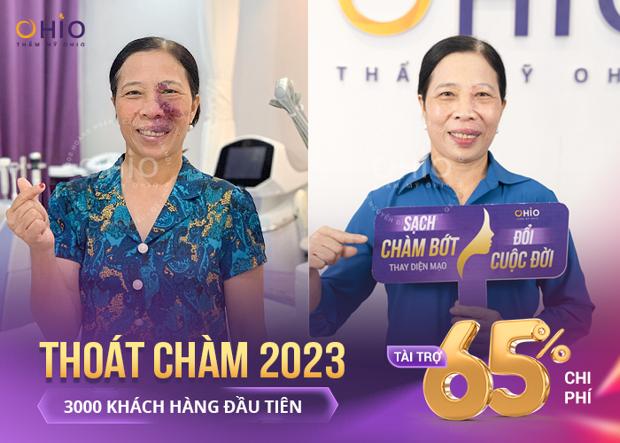 Hè sang ngập tràn quà tặng - Giảm 65% dịch vụ HOT - 500 voucher làm đẹp - Phòng khám da liễu OHIO Hè sang ngập tràn quà tặng - Giảm 65% dịch vụ HOT - 500 voucher làm đẹp