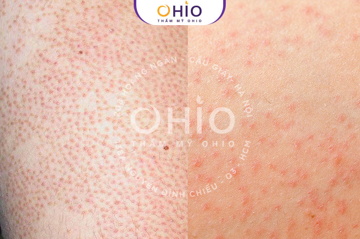 Bật mí phương pháp triệt lông cho nữ an toàn và hiệu quả - Phòng khám da liễu OHIO phương pháp triệt lông cho nữ an toàn
