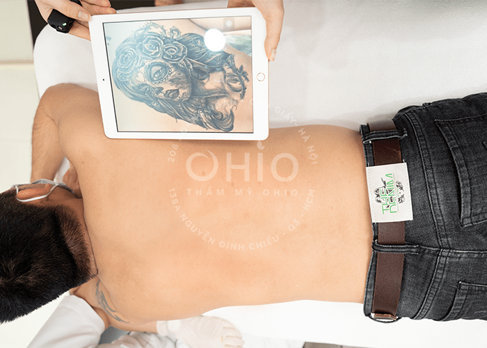 Chi phí xóa hình xăm mới 2023 - Phòng khám da liễu OHIO Chi phí xóa hình xăm mới 2023