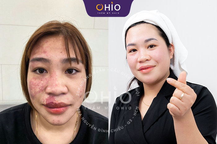 “Mách bạn” phương pháp điều trị bớt sắc tố da hiệu quả - Phòng khám da liễu OHIO “Mách bạn” phương pháp điều trị bớt sắc tố da hiệu quả