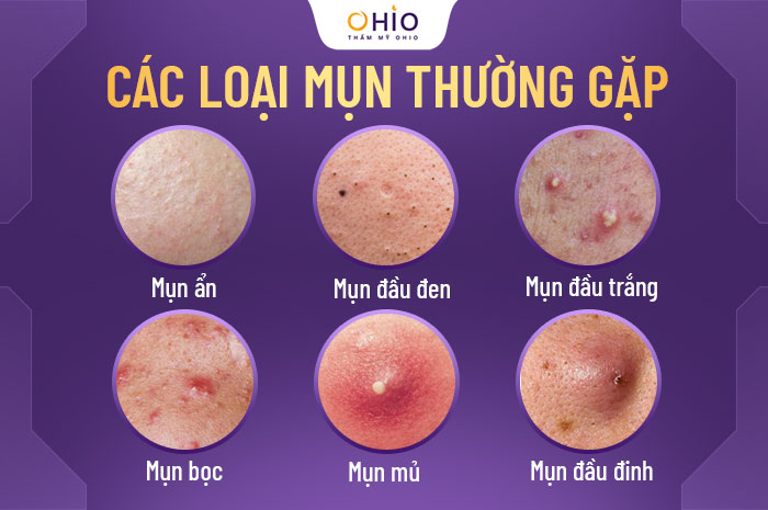 phương pháp trị mụn hiệu quả