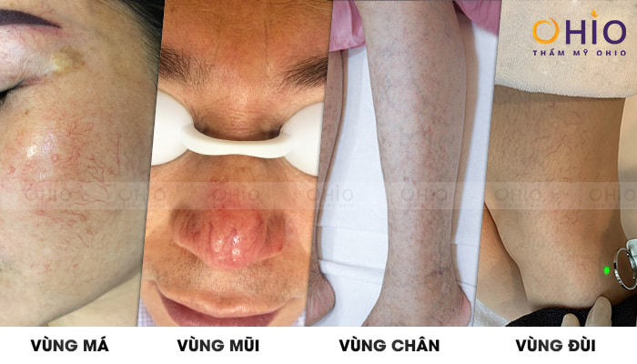 Chi phí điều trị giãn mao mạch có đắt không ? - Phòng khám da liễu OHIO Chi phí điều trị giãn mao mạch