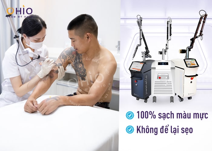 Chi phí xóa hình xăm mới 2023 - Phòng khám da liễu OHIO chi phí xoá hình xăm 2