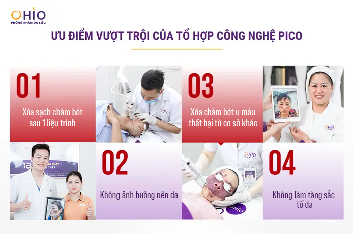 Xóa sạch chàm bớt với tổ hợp công nghệ PICO: Không ảnh hưởng nền da, an toàn, hiệu quả - Phòng khám da liễu OHIO Xóa sạch chàm bớt với tổ hợp công nghệ PICO: Không ảnh hưởng nền da, an toàn, hiệu quả